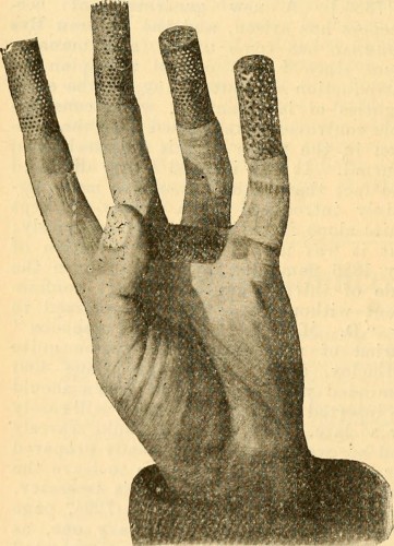 An illustration from a book showing a person's hand with little cage=like things extending from the ends of the fingers.