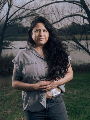 Photograph of Vanessa Ramos, who now has a port in her abdomen for her chemotherapy treatments due to vasculitis resulting from COVID-19.
Credit: Jordan Vonderhaar for the Texas Observer 