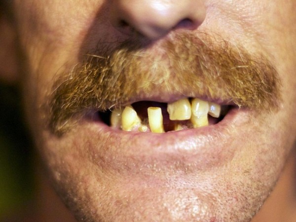 Gros plan sur la bouche d'un homme moustachu à la santé dentaire compliquée