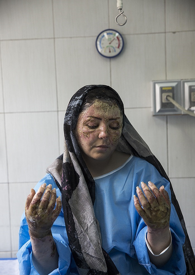This is a photo of a woman who was a victim of an acid attack. She is wearing a sky blue loose gown and a gray and black head covering. Her hair is black and her skin is medium-brown. She is holding her hands up in front of her and looking at them. Her face and hands have burn scars covering them. She looks like the Virgin Mary.