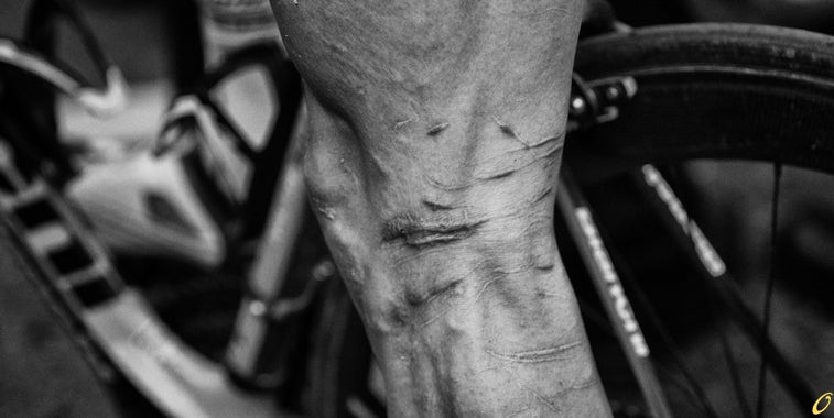 Johnny Hoogerland’s legs scarred from his battle with barbed wire at 2011 Tour de France. Via Cycling Tips