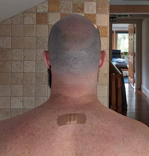 Photo of my head, neck, and upper back viewed from behind. A large adhesive bandage ("bandaid") covers a spot at the base of my neck where I recently received an epidural injection 