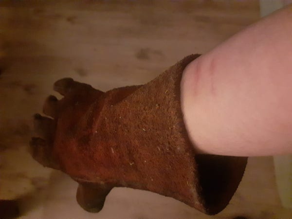 A welding gauntlet on an arm, with two burn marks a couple of centimetres above where the gauntlet ends.