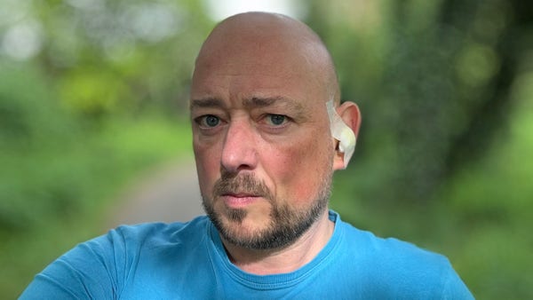 Photo, landscape, exterior: A selfie of a handsome, somewhat unshaven bald man with a patch over one ear in a blue t-shirt with blurred parkland behind. He can’t hear everything you say, but he is listening, mostly.