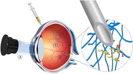 Illustration of microscopic spirals being injected into an eye.
