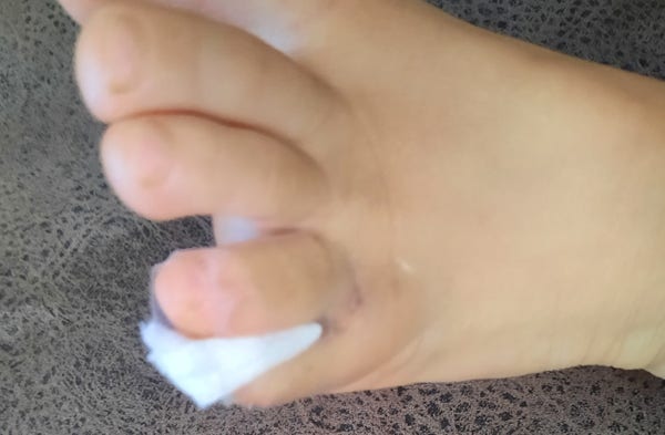 Picture of a kids foot where the pinky toe is bandaided