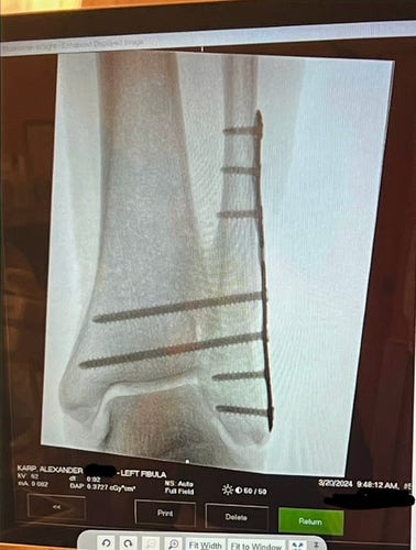 An x-ray of my left ankle, showing a metal plate and seven screws holding my ankle together.